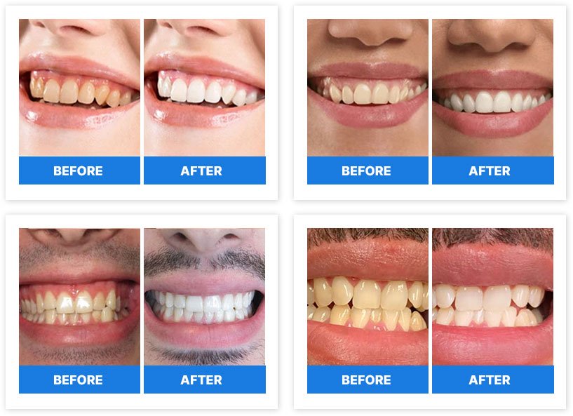 Four before-and-after smile comparisons showing visibly whiter teeth